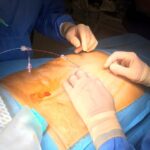 Primo intervento di neurostimolazione gangliare al “San Giovanni di Dio” di Agrigento